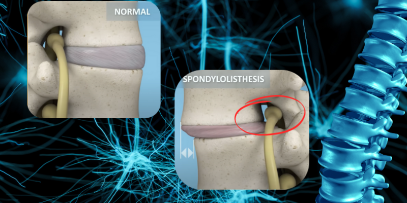 Bel Kayması Tedavisi