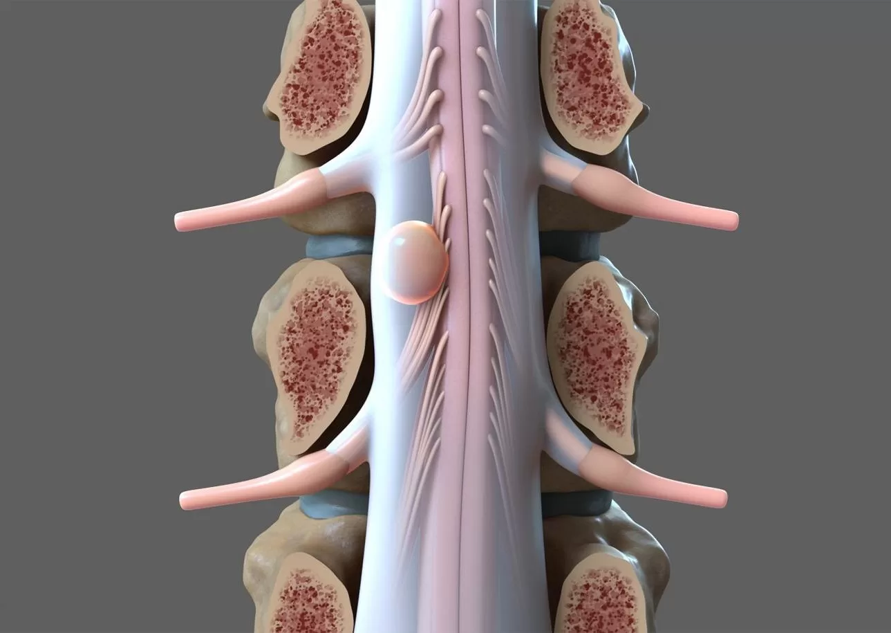 Brain and Spinal Cord Tumors