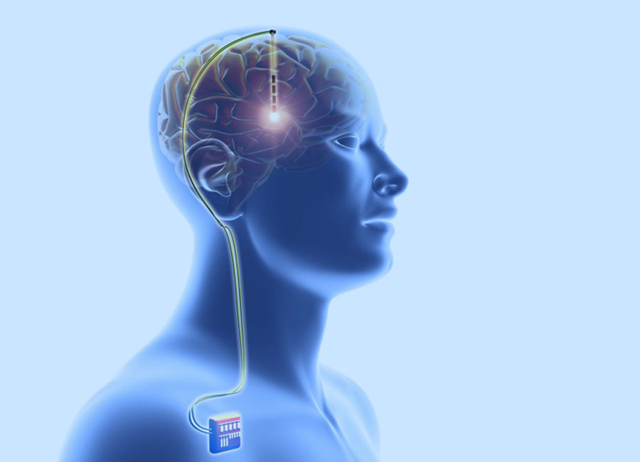Deep Brain Stimulation (DBS)