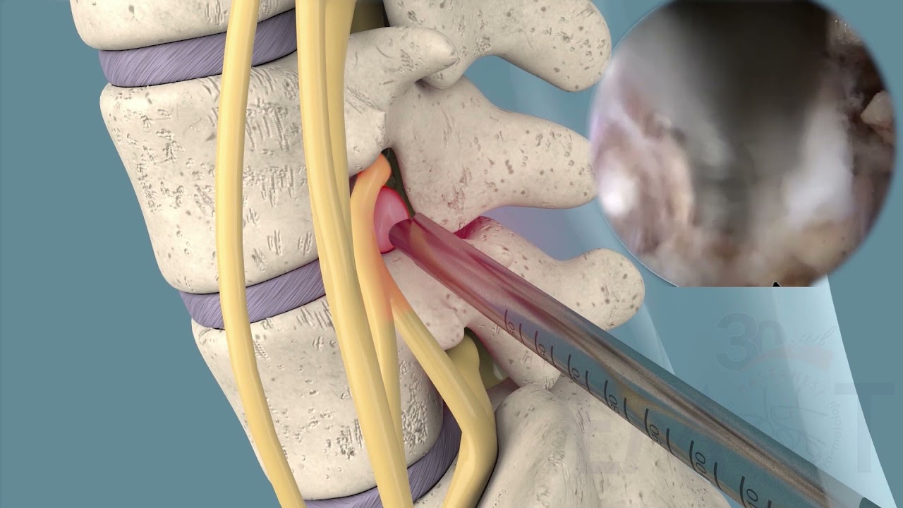 Tam Kapalı Endoskopik Bel Fıtığı Ameliyatı