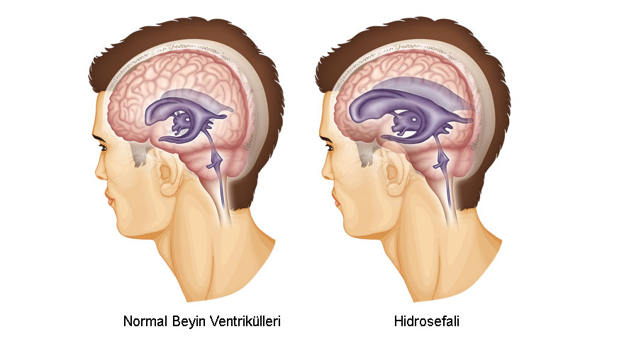 Hydrocephalus and Shunt Surgery